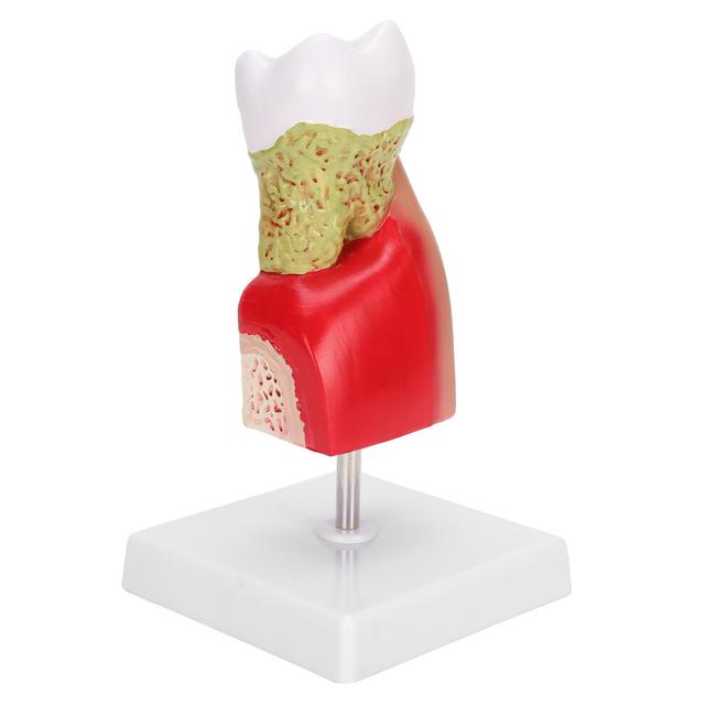 Dental Caries Tooth Model for Teaching & Training, Resin+ABS, 19x10.5x4cm